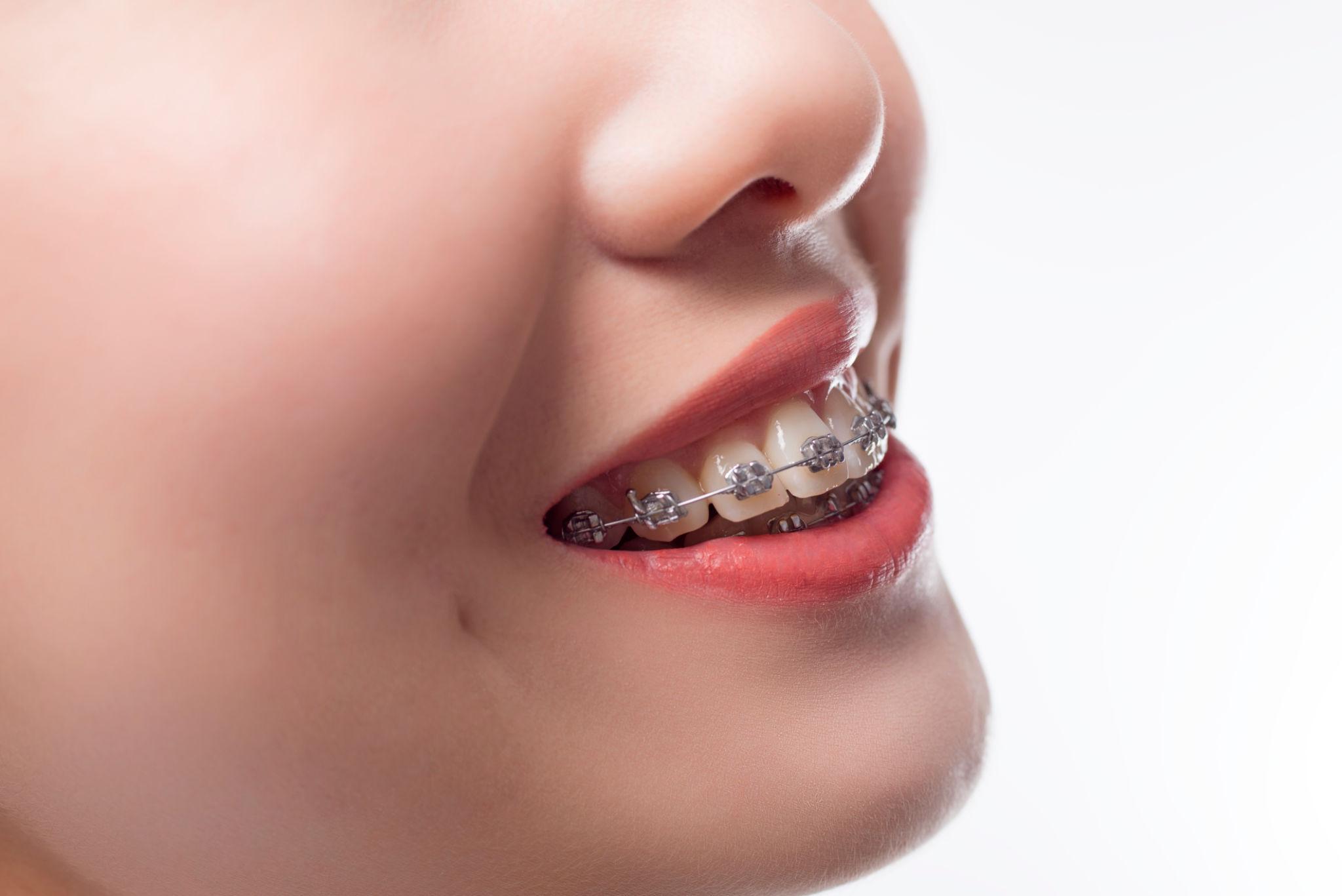 Metal Braces